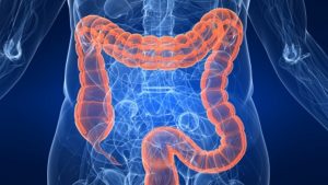 Kαρκίνος του παχέος εντέρου: πρόληψη